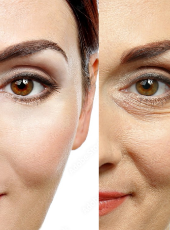 Wrinkle Reduction